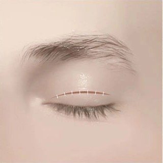 절개선을 봉합하여 마무리하는 일러스트
