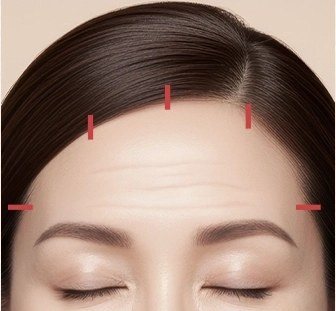 이마 헤어라인 최소 절개 일러스트