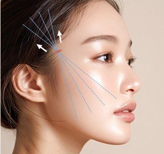 실 삽입 및 당김 방향을 나타낸 일러스트