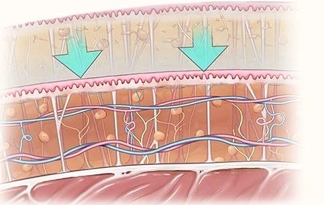지방흡입 후 얇아지는 지방층 일러스트