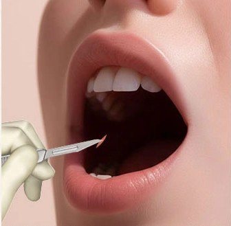 입안을 절개하는 일러스트