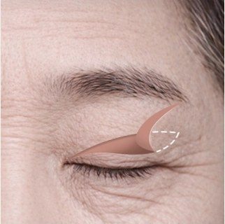 상안검 수술 과정: 절개 후 지방 및 눈둘레근 제거 일러스트