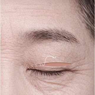 상안검 수술 과정: 근막과 피부 봉합 일러스트