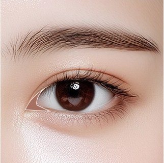앞트임 수술 가이드선이 표시된 눈