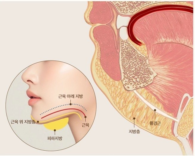 턱밑 지방층과 광경근 해부학 구조 및 이중턱 단면 설명 일러스트