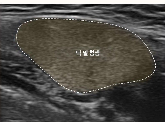 턱 밑 침샘 초음파 영상