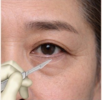 결막을 절개하여 눈 밑 지방을 제거하는 수술 과정 일러스트