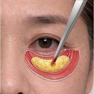 눈 밑에 지방이식을 진행하는 수술 과정 일러스트