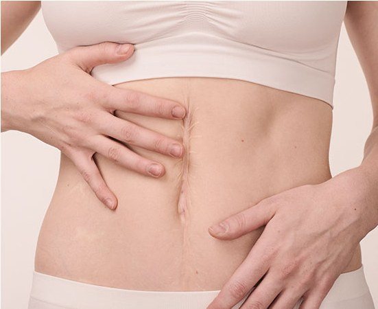 복부의 세로 수술 흉터를 손으로 만지고 있는 모습