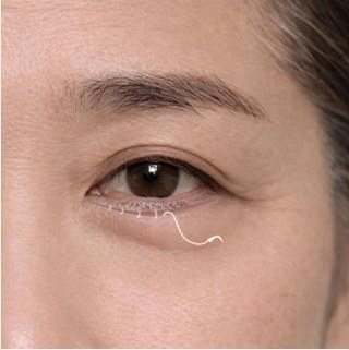 하안검 수술 과정: 근육 고정 및 피부 절제 봉합