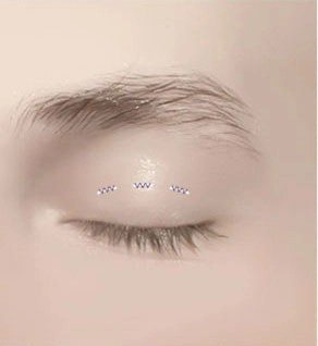 구멍을 봉합하여 눈매를 완성하는 수술 과정 일러스트