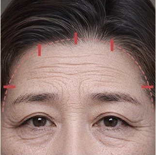 눈 옆 헤어라인 절개 수술 일러스트