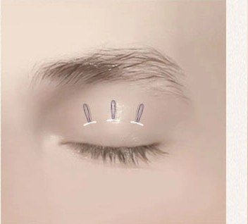 실을 삽입하여 안륜근을 강화하는 눈 수술 과정 일러스트
