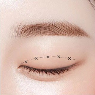 쌍꺼풀 맞춤형 라인 미세 절개 과정 일러스트