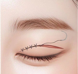 절개 부위를 봉합하는 수술 과정 일러스트