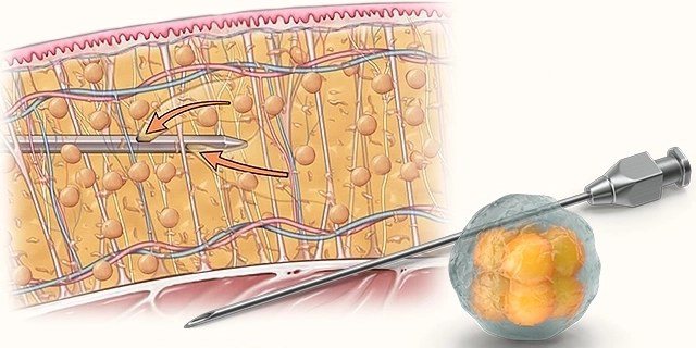 얼굴지방흡입 캐뉼라 시술 일러스트