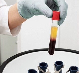 원심분리기와 채취된 지방 시험관