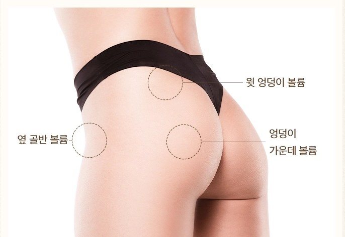 바디 필러 시술 부위 다이어그램 (윗 엉덩이 볼륨, 엉덩이 가운데 볼륨, 옆 골반 볼륨)